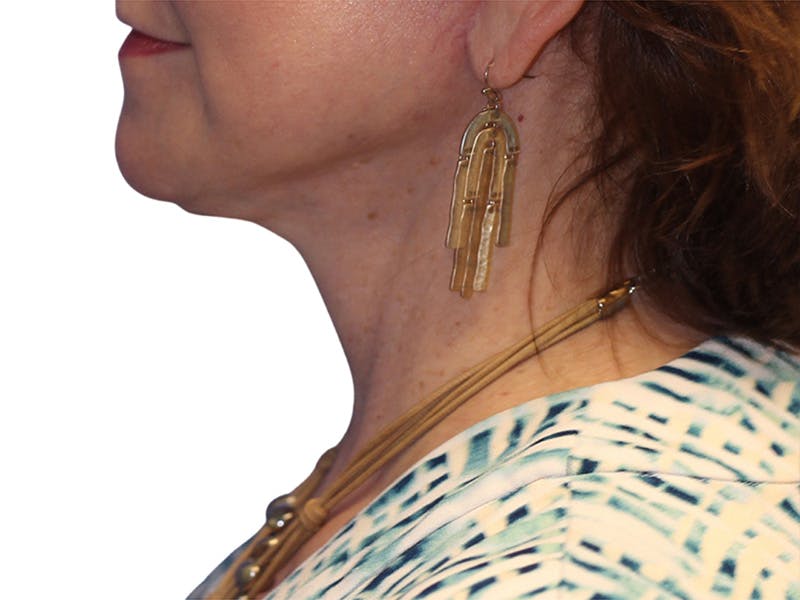 Neck Lift Before & After Gallery - Patient 217704 - Image 4
