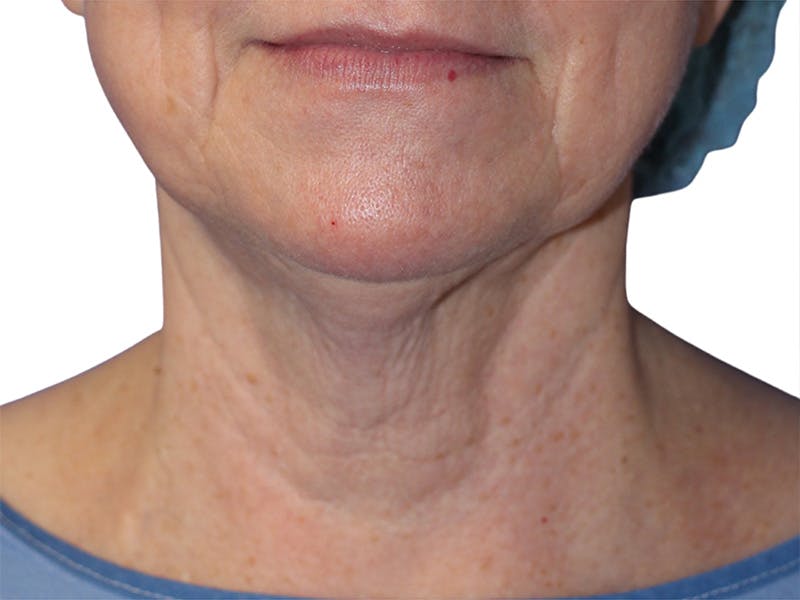 Neck Lift Before & After Gallery - Patient 217704 - Image 5