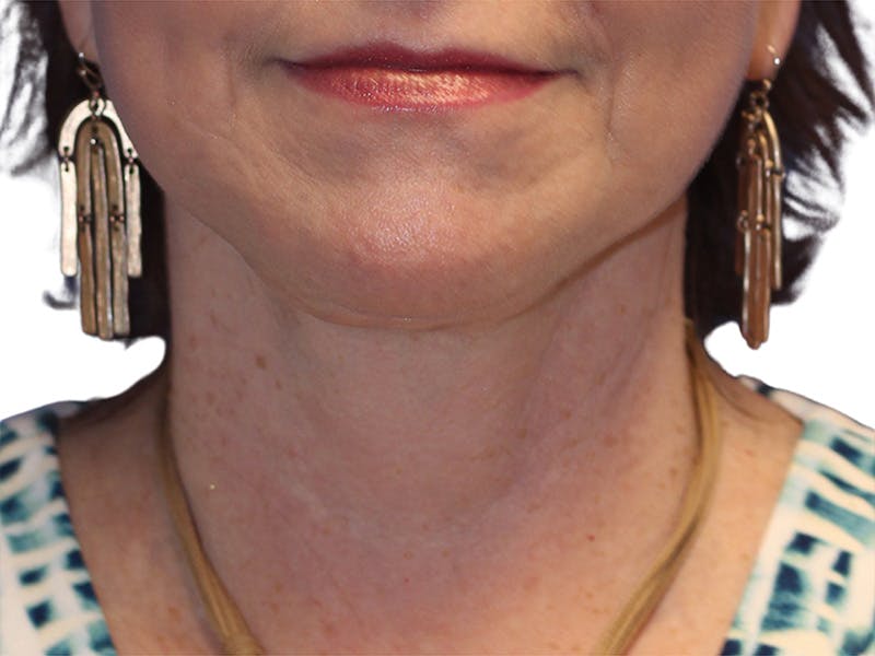 Neck Lift Before & After Gallery - Patient 217704 - Image 6