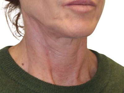 Neck Lift Before & After Gallery - Patient 121250 - Image 1