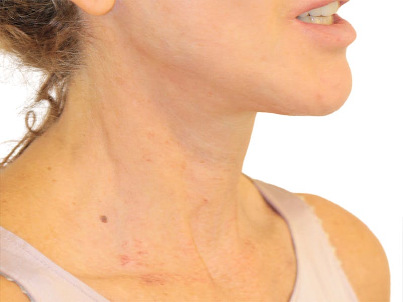 Neck Lift Before & After Gallery - Patient 121250 - Image 2