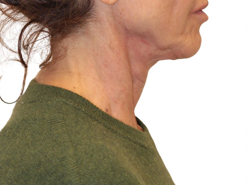 Neck Lift Before & After Gallery - Patient 121250 - Image 3