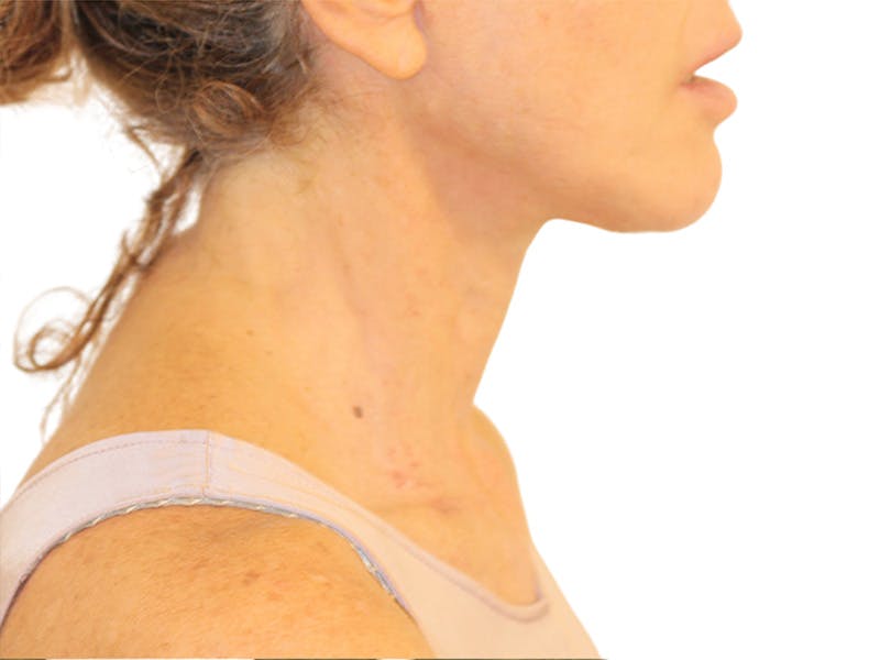 Neck Lift Before & After Gallery - Patient 121250 - Image 4