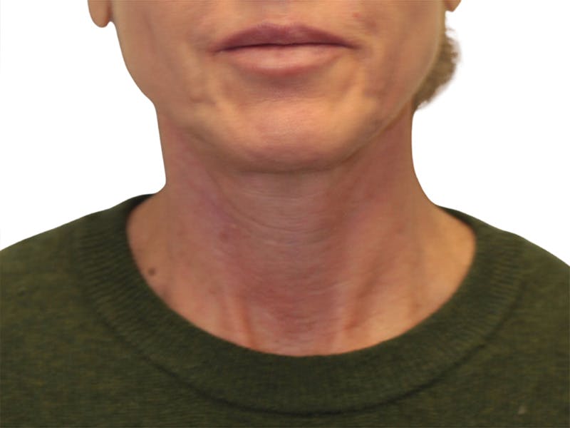 Neck Lift Before & After Gallery - Patient 121250 - Image 5