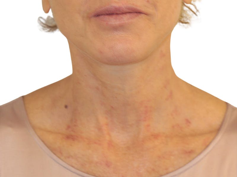 Neck Lift Before & After Gallery - Patient 121250 - Image 6
