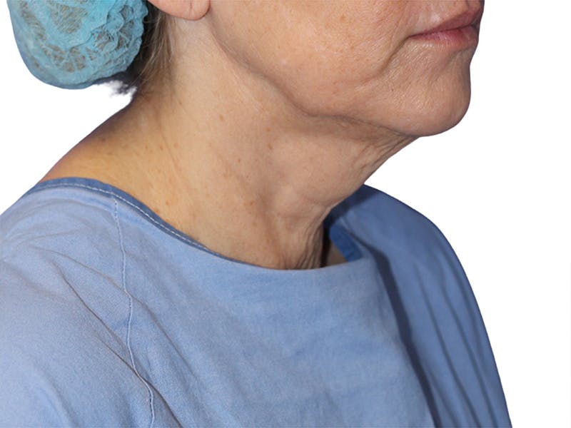 Neck Lift Before & After Gallery - Patient 137687 - Image 1