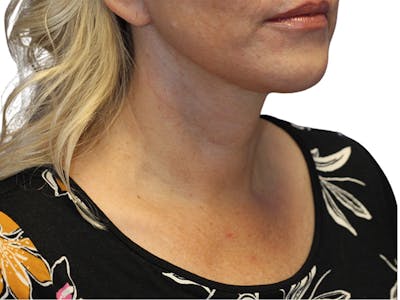 Neck Lift Before & After Gallery - Patient 137687 - Image 2