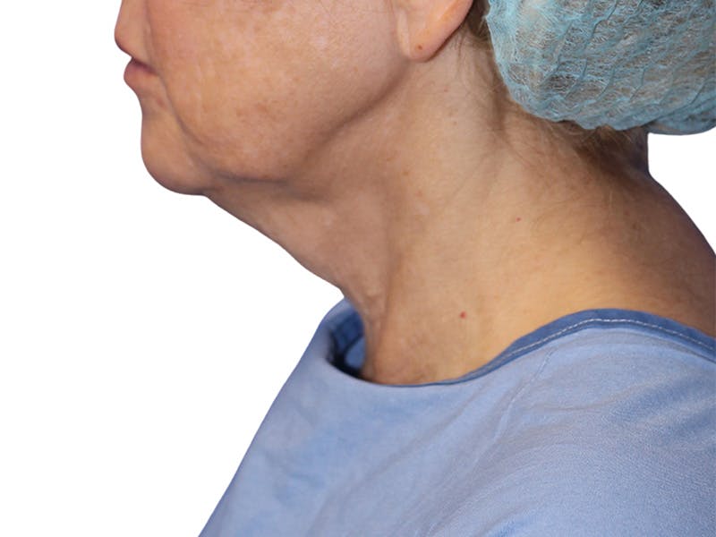 Neck Lift Before & After Gallery - Patient 137687 - Image 3