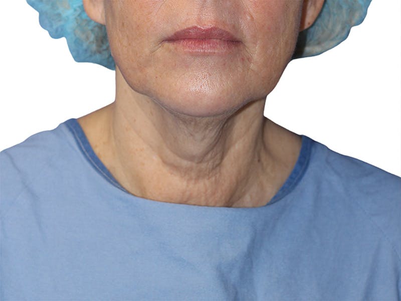 Neck Lift Before & After Gallery - Patient 137687 - Image 5