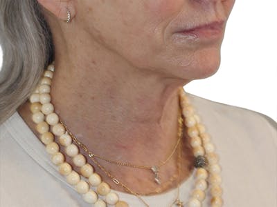 Neck Lift Before & After Gallery - Patient 445578 - Image 1