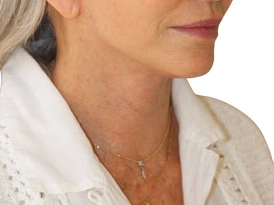 Neck Lift Before & After Gallery - Patient 445578 - Image 2