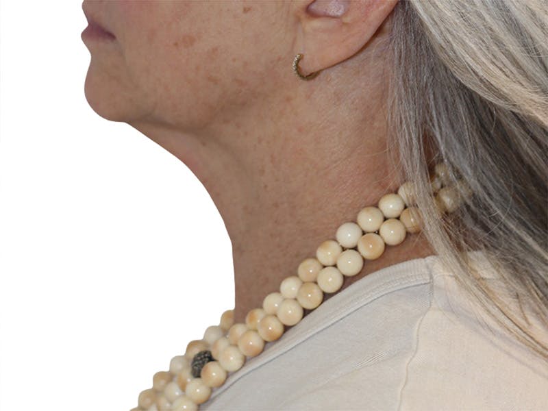 Neck Lift Before & After Gallery - Patient 445578 - Image 3