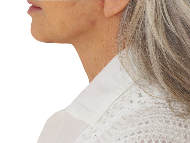 Neck Lift Before & After Gallery - Patient 445578 - Image 4