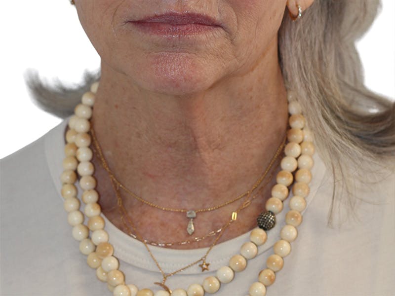 Neck Lift Before & After Gallery - Patient 445578 - Image 5