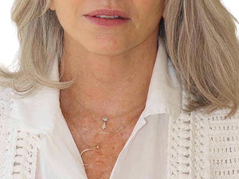 Neck Lift Before & After Gallery - Patient 445578 - Image 6