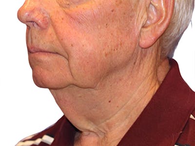 Neck Lift Before & After Gallery - Patient 164838 - Image 1