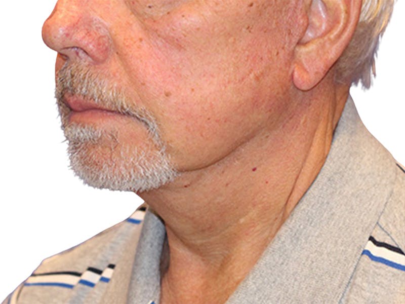 Neck Lift Before & After Gallery - Patient 164838 - Image 2