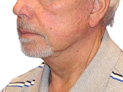 Neck Lift Before & After Gallery - Patient 164838 - Image 2