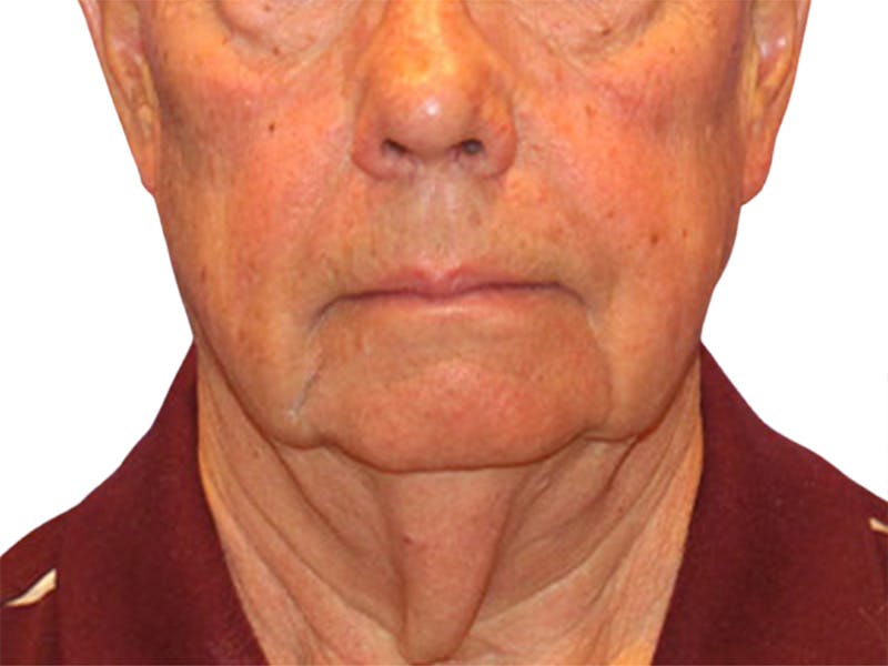 Neck Lift Before & After Gallery - Patient 164838 - Image 3