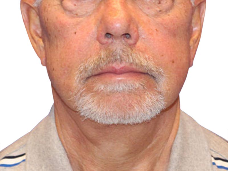 Neck Lift Before & After Gallery - Patient 164838 - Image 4