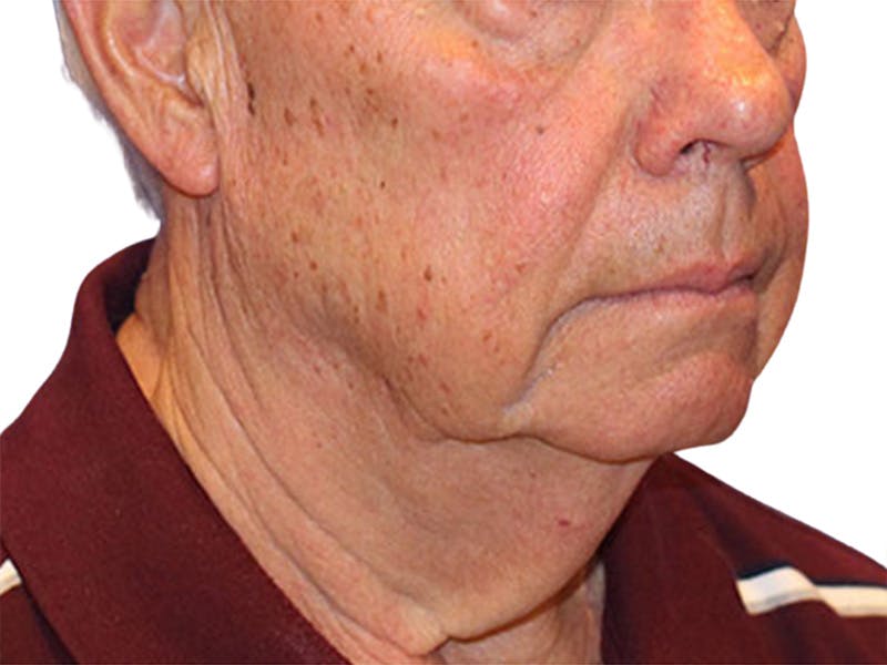Neck Lift Before & After Gallery - Patient 164838 - Image 5