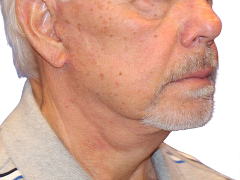 Neck Lift Before & After Gallery - Patient 164838 - Image 6