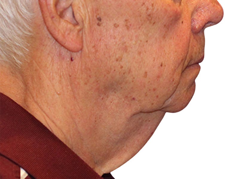 Neck Lift Before & After Gallery - Patient 164838 - Image 7