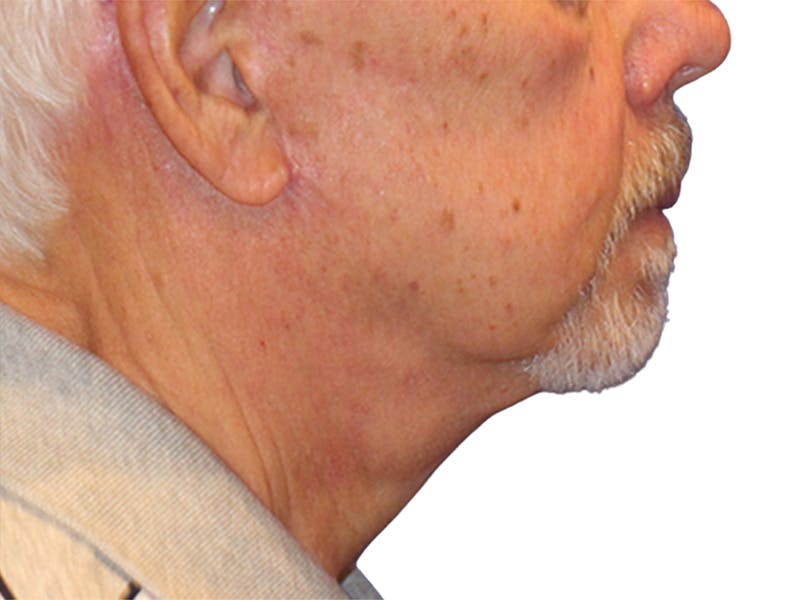 Neck Lift Before & After Gallery - Patient 164838 - Image 8