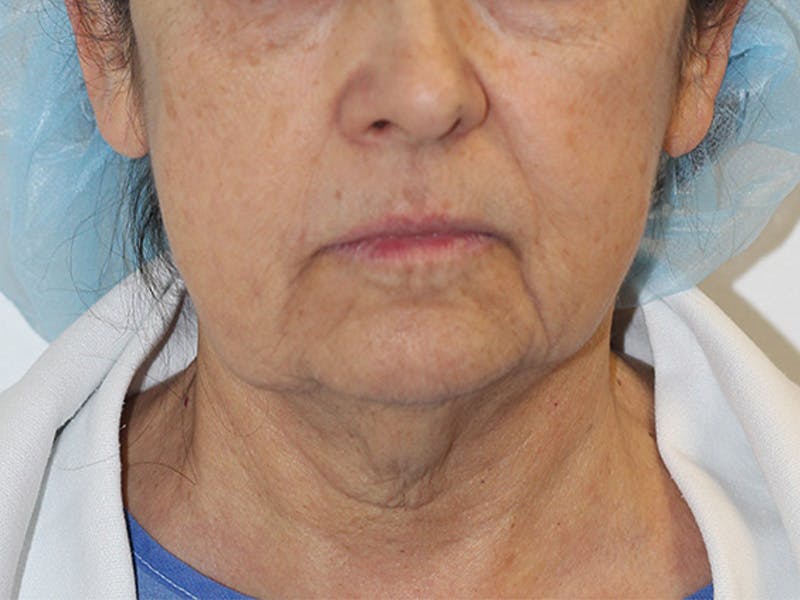 Neck Lift Before & After Gallery - Patient 236014 - Image 1