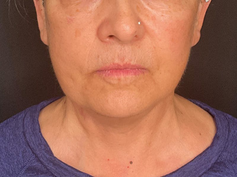 Neck Lift Before & After Gallery - Patient 236014 - Image 2
