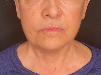 Neck Lift Before & After Gallery - Patient 236014 - Image 2