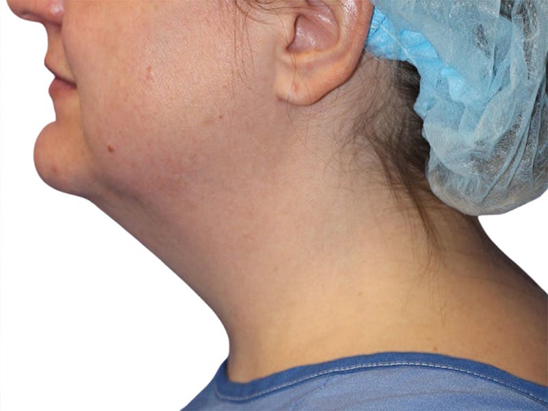 Neck Lift Before & After Gallery - Patient 317810 - Image 1