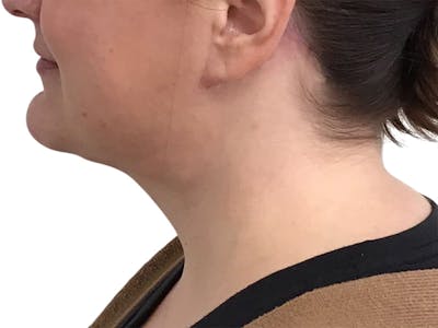 Neck Lift Before & After Gallery - Patient 317810 - Image 2