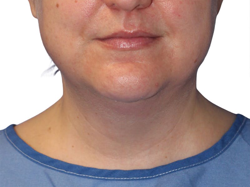 Neck Lift Before & After Gallery - Patient 317810 - Image 3