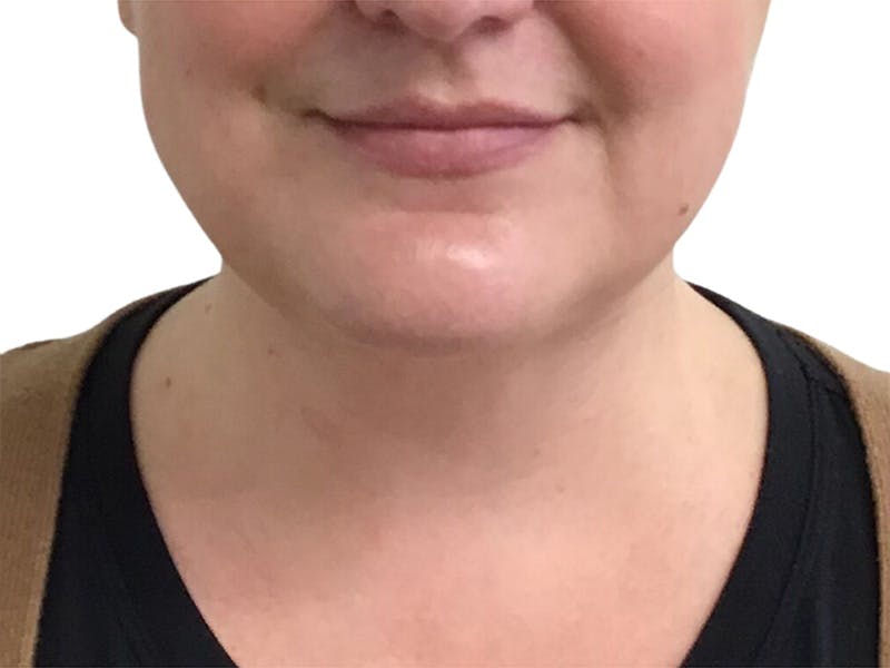 Neck Lift Before & After Gallery - Patient 317810 - Image 4