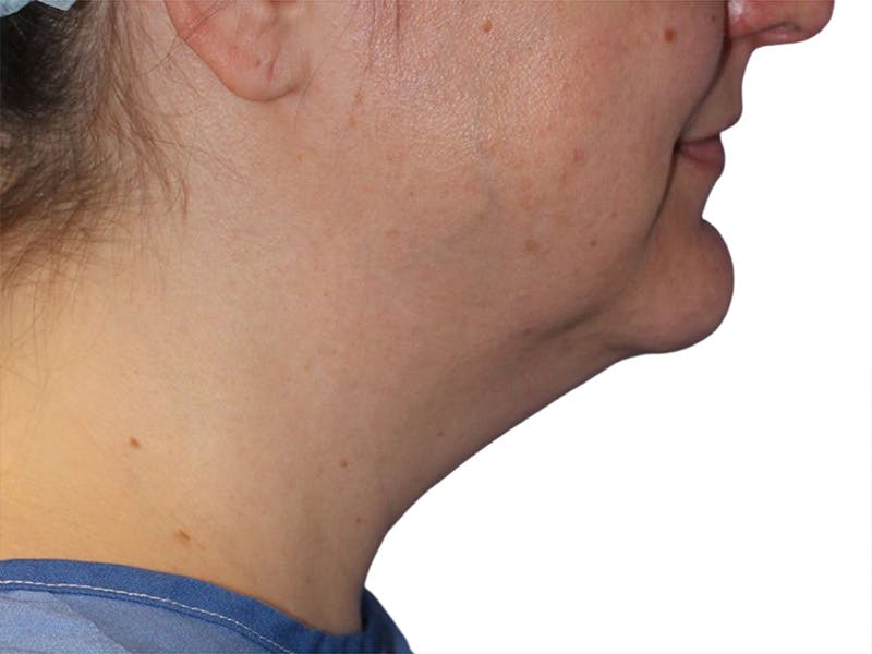 Neck Lift Before & After Gallery - Patient 317810 - Image 5