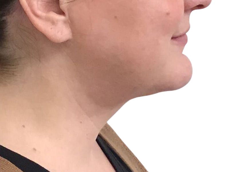 Neck Lift Before & After Gallery - Patient 317810 - Image 6