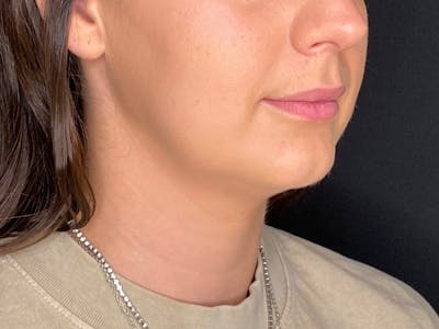Neck Liposuction Before & After Gallery - Patient 707334 - Image 1