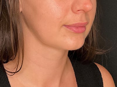 Neck Liposuction Before & After Gallery - Patient 707334 - Image 2