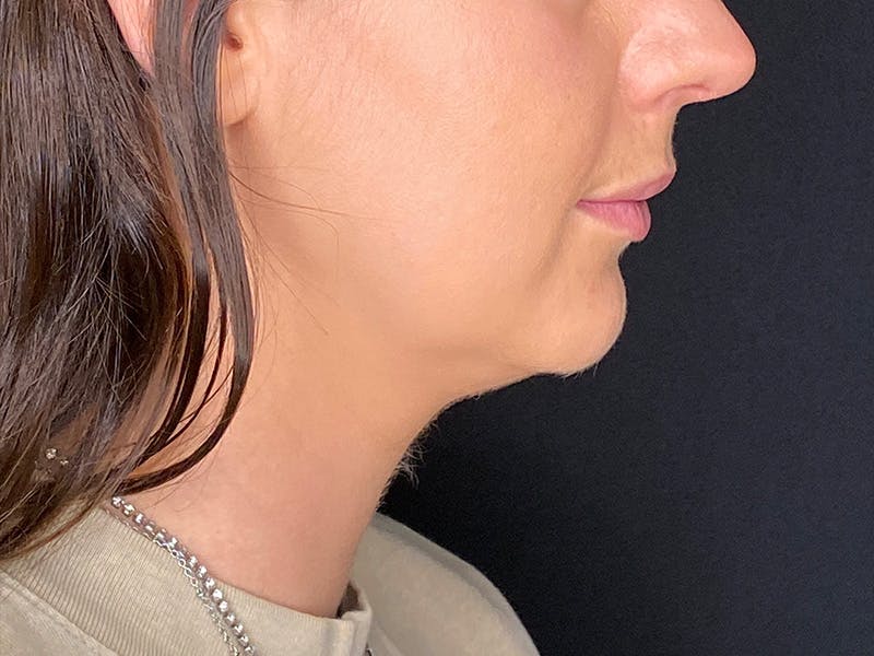 Neck Liposuction Before & After Gallery - Patient 707334 - Image 3