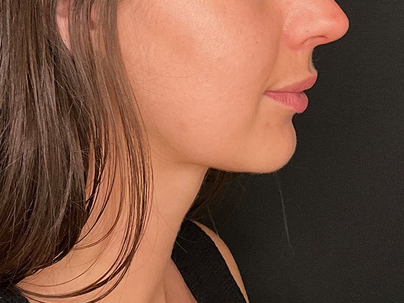 Neck Liposuction Before & After Gallery - Patient 707334 - Image 4