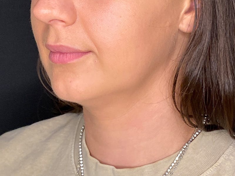 Neck Liposuction Before & After Gallery - Patient 707334 - Image 5