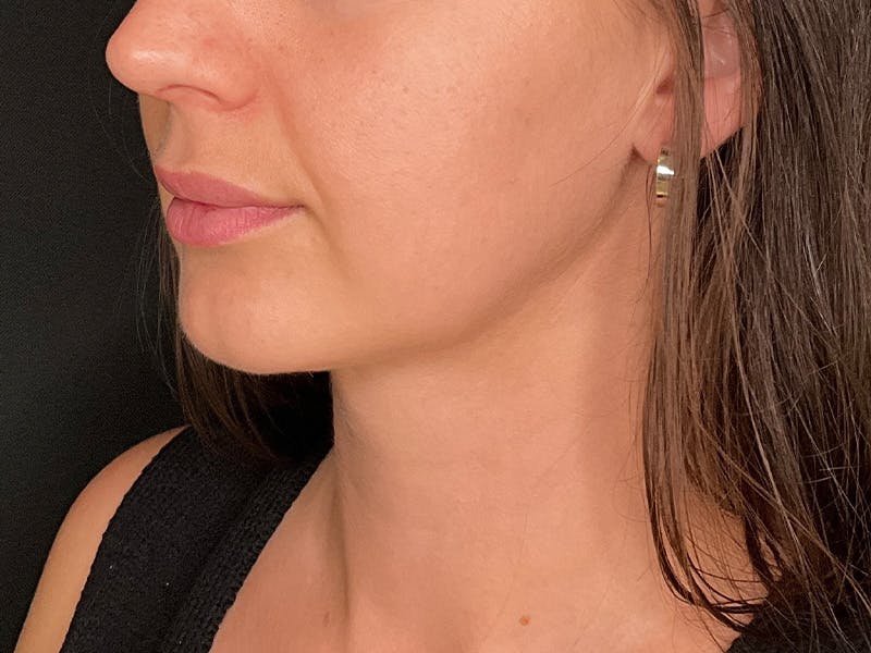 Neck Liposuction Before & After Gallery - Patient 707334 - Image 6