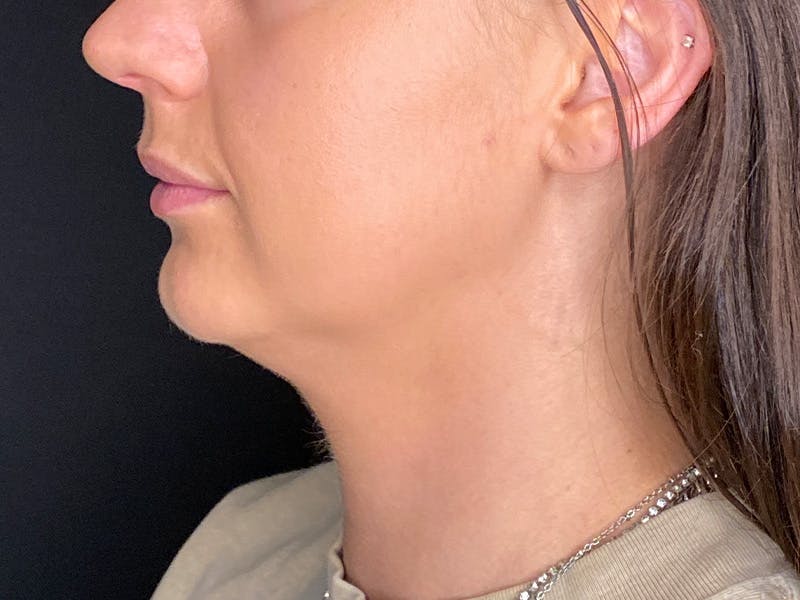 Neck Liposuction Before & After Gallery - Patient 707334 - Image 7