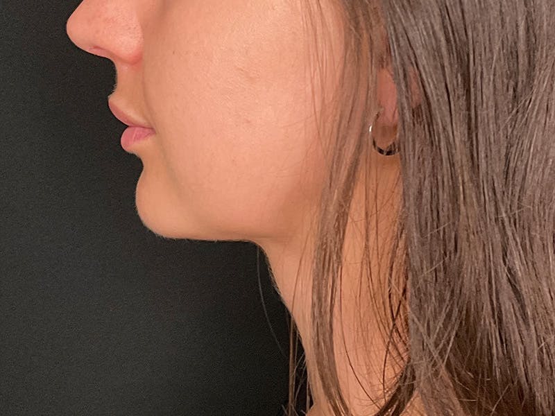 Neck Liposuction Before & After Gallery - Patient 707334 - Image 8