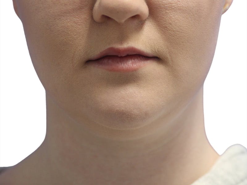 Neck Liposuction Before & After Gallery - Patient 142839 - Image 1