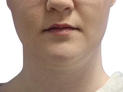 Neck Liposuction Before & After Gallery - Patient 142839 - Image 1