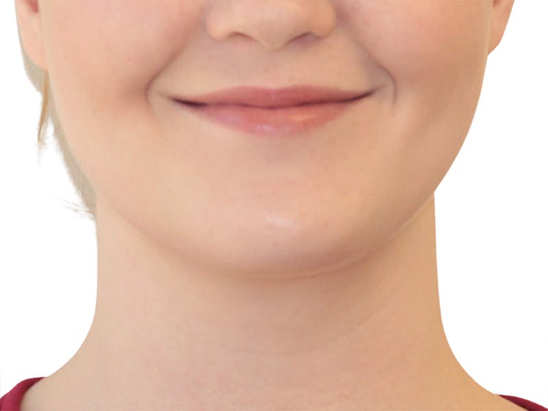 Neck Liposuction Before & After Gallery - Patient 142839 - Image 2