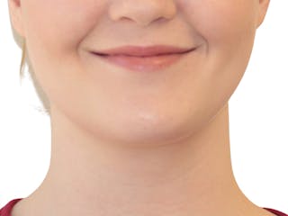 Neck Liposuction Before & After Gallery - Patient 142839 - Image 2