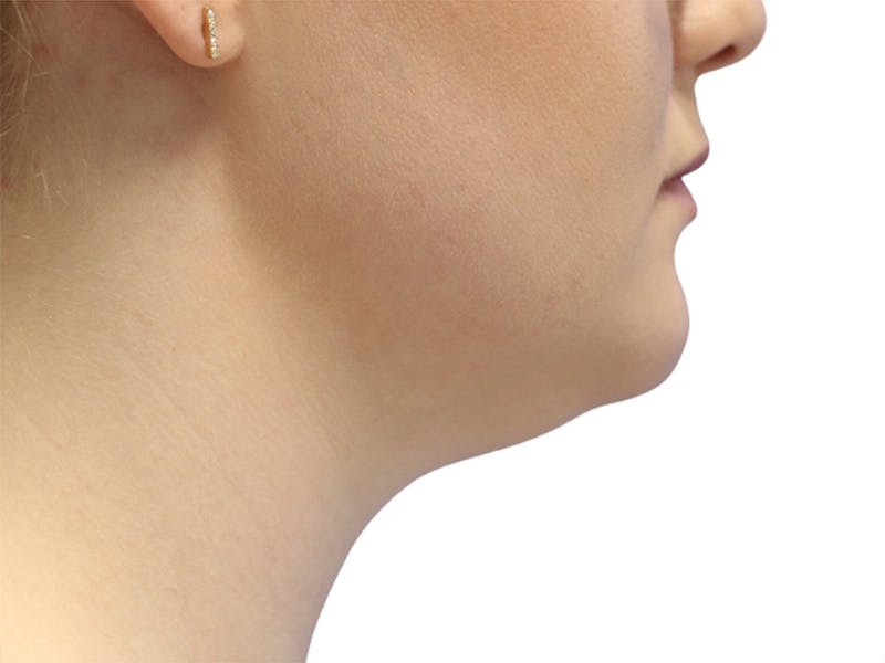 Neck Liposuction Before & After Gallery - Patient 142839 - Image 3